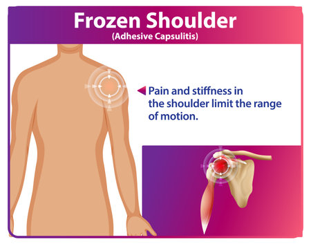 Illustration of frozen shoulder and its symptomsのイラスト素材