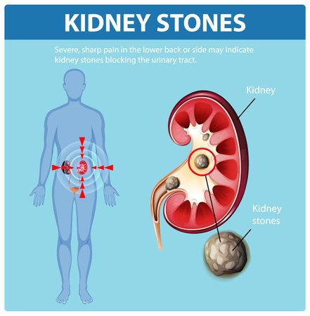 Illustration of kidney stones causing severe painのイラスト素材