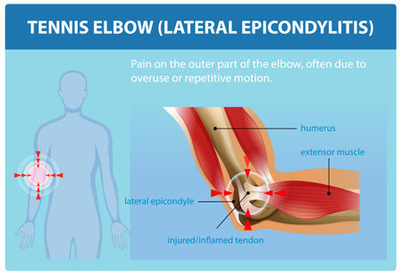 Illustration of tennis elbow anatomy and symptomsのイラスト素材