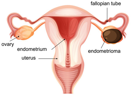 Vector illustration of female reproductive system highlighting uterus, ovaries, and endometrioma. Clear labels and anatomical accuracyのイラスト素材