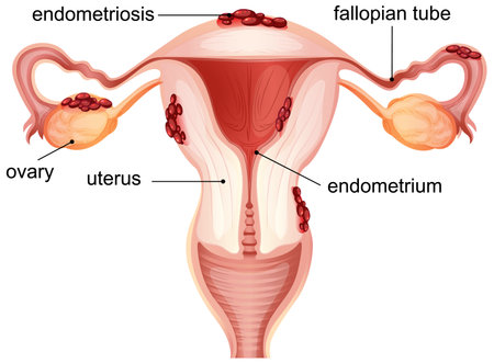 Vector illustration highlighting endometriosis in the female reproductive system, featuring labeled anatomy and vibrant colorsのイラスト素材