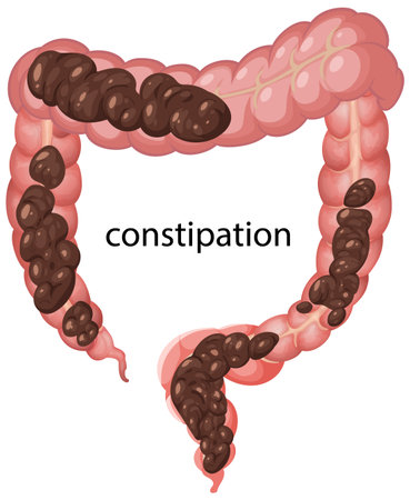 Vector illustration of the human colon showing constipation. Detailed anatomical depiction with realistic colors and clear labelingのイラスト素材