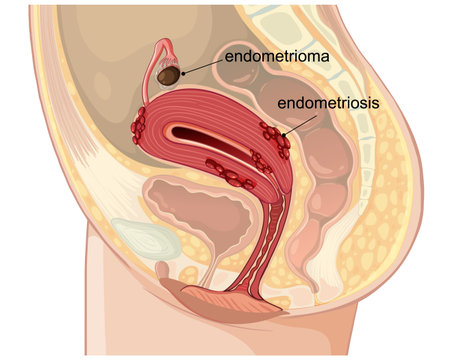 Vector illustration showing endometriosis and endometrioma in the female reproductive system. Clear labeling and anatomical accuracyのイラスト素材