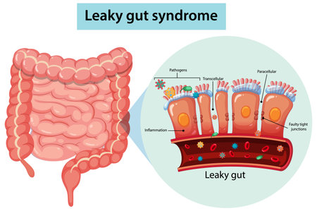 Detailed vector diagram of human intestines and leaky gut syndrome, highlighting inflamed intestinal lining, pathogens, and cellular junctions in flat design styleのイラスト素材