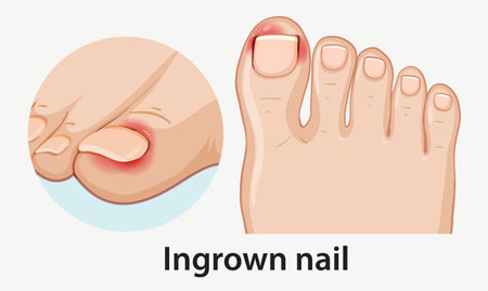 Medical vector illustration showing an inflamed ingrown toenail on a foot, with close-up detail, flat design, and clear anatomical accuracyのイラスト素材