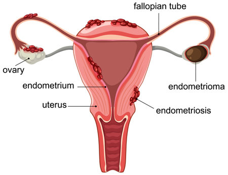 Vector illustration of the female reproductive system highlighting endometriosis and related structures with labeled parts for educational purposesのイラスト素材