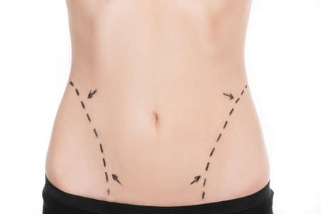 Body improving. Close-up of female body with marks on abdomenの写真素材