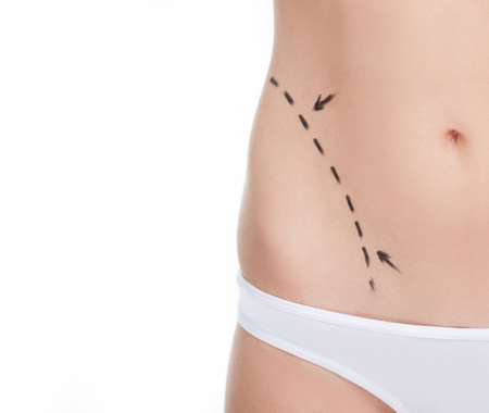 Body improving. Close-up cropped image of female body with marks on abdomenの写真素材
