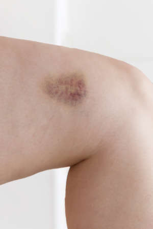 painful knee injury with bruiseの写真素材