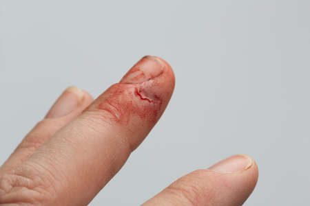 A cut injury on fingerの写真素材