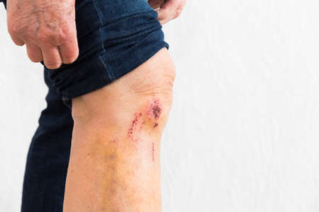 leg with some scrapes from a topplingの写真素材