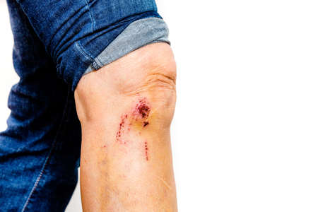 leg with some scrapes from a topplingの写真素材