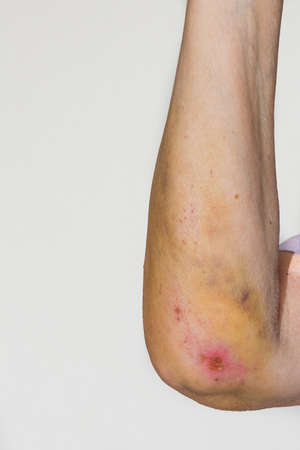 female arm with big bruises from a fallの写真素材