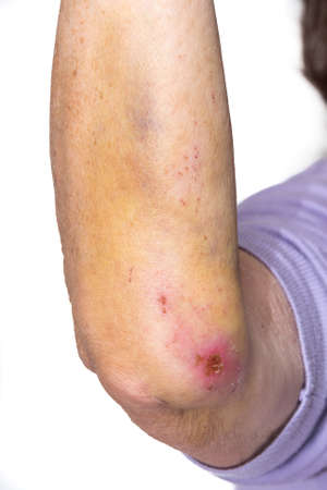 female arm with big bruises from a fallの写真素材