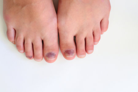 Toenails with bruise after hiking, injured nails, body traumaの写真素材