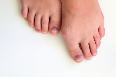 Toenails with bruise after hiking, injured nails, body traumaの写真素材