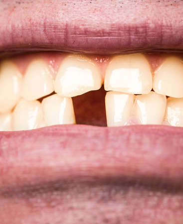 Yellow teeth. Bad dental health, no teeth, no fluoride, tooth erosion. Yellow bad teeth. Man without one front tooth. No teeth. Smile men with a lost front tooth, toothacheの写真素材