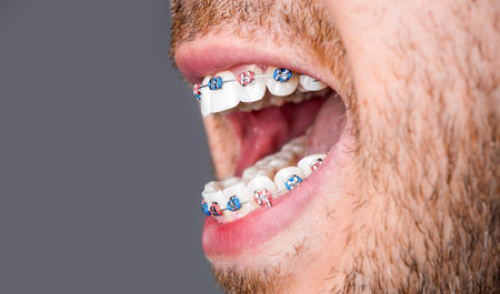 Close to the teeth braces on the white teeth of man to equalize the teeth. Bracket system in smiling...
