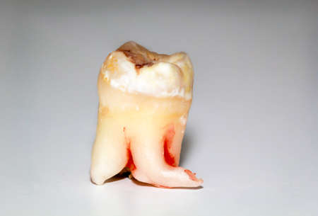 A close-up of an extracted wisdom tooth with a grumbling root.の写真素材