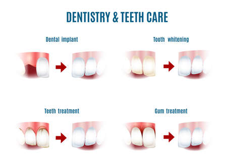 Illustration of teeth care procedures. Iplants, whitening, gum and oral cavity. Free font Antonio used. Isolated on whiteのイラスト素材