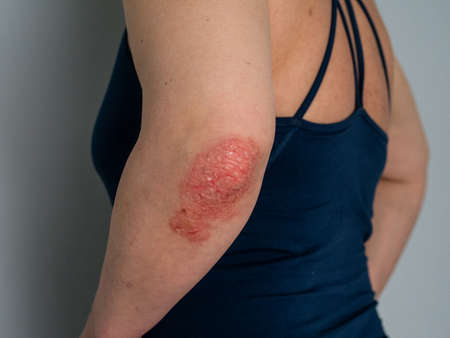 Psoriasis on elbow. Isolated. Closeup of rash and scaling on the patient's skin. The concept of chronic disease treatment. Dermatological problems. Hard, horny and cracked skin in woman's handsの写真素材