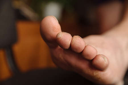 Fungus on the toes close up.Fungal infection on the legの写真素材