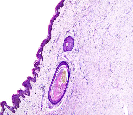 Histology of human tissue, show skin with hair follicles as seen under the microscope.