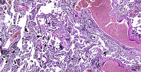 Histology of human tissue, show chronic congestion of lung as seen under the microscope