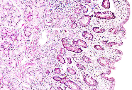 Histology of human tissue, show gastric mucosa intestinal metaplasia as seen under the microscope,...