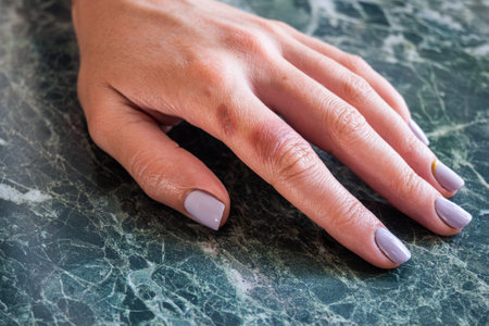 Small local burns on the girl's hand, burns on the finger. High quality photoの写真素材