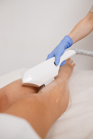 Close up of hair removing procedure on legs. Laser epilation and cosmetology in beauty salonの写真素材