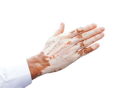 Man's hand with with vitiligo on white background.の写真素材