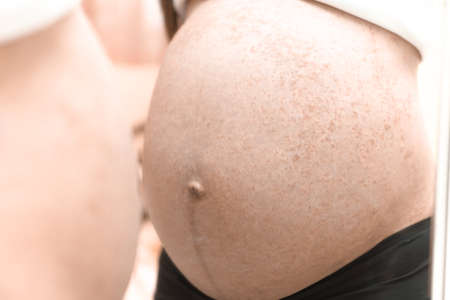 Allergy on pregnant belly, itchy on the skinの写真素材