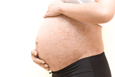 Allergy on pregnant belly, itchy on the skin