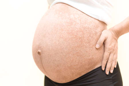 Allergy on pregnant belly, itchy on the skinの写真素材