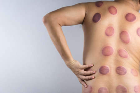 A man back with blood marks massaged after taking Chinese cupping therapy