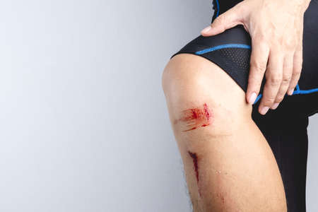 Fresh bruise knee wound injury with some small stone and dust left from bike accident on white backgroundのeditorial素材