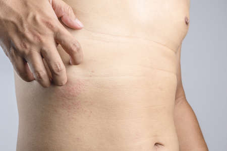 Man hand scratching an itch on red mark sensitive skin as food or pest allergy symptoms on white...