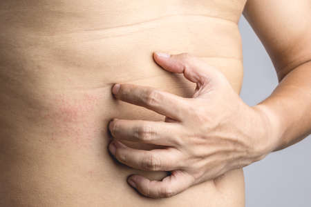 Man hand scratching an itch on red mark sensitive skin as food or pest allergy symptoms on white backgroundの写真素材