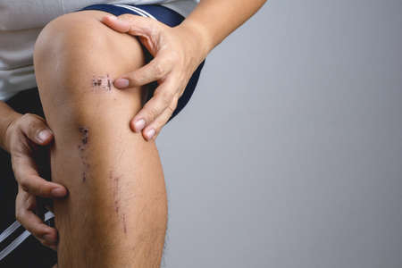 Bruise knee wound scab injury with some small on leg skin from fall or bike accident on white backgroundのeditorial素材