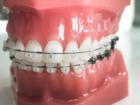 Model of human jaw with wire braces attached. Dental and orthodontic office and lab presentation tool, dental care and orthodontics conceptの写真素材