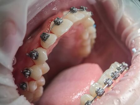 Model of human jaw with wire braces attached. Dental and orthodontic office and lab presentation...