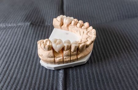 Artificial chew with made tooth crowns and veneers is standing on the table in the dental laboratory. Technical and professional equipmentの写真素材