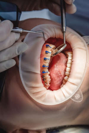 Dentist doctor installs braces system on teeth, close-up of open mouth. Health care and dental...