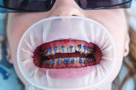 Dentist doctor installs braces system on teeth, close-up of open mouth. Health care and dental treatment conceptの写真素材