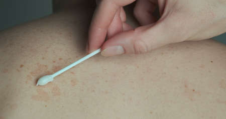 Doctor lubricates the red spots on the back of the patient with an ointment with a cotton swab....