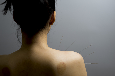 acupuncture treat conceptの写真素材