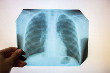 Chest x-ray into the lumen on a white screen. Ribs and lungs in x-rayの写真素材