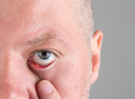 Close up of stye in the eye at the lower eyelid. Hordeolum or Chalazion of a male patientの写真素材