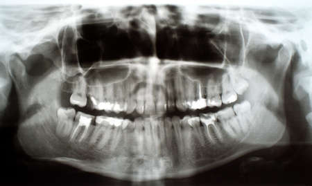 Panoramic, full mouth dental xray  X-ray of human teeth  Root canal treatment photo 